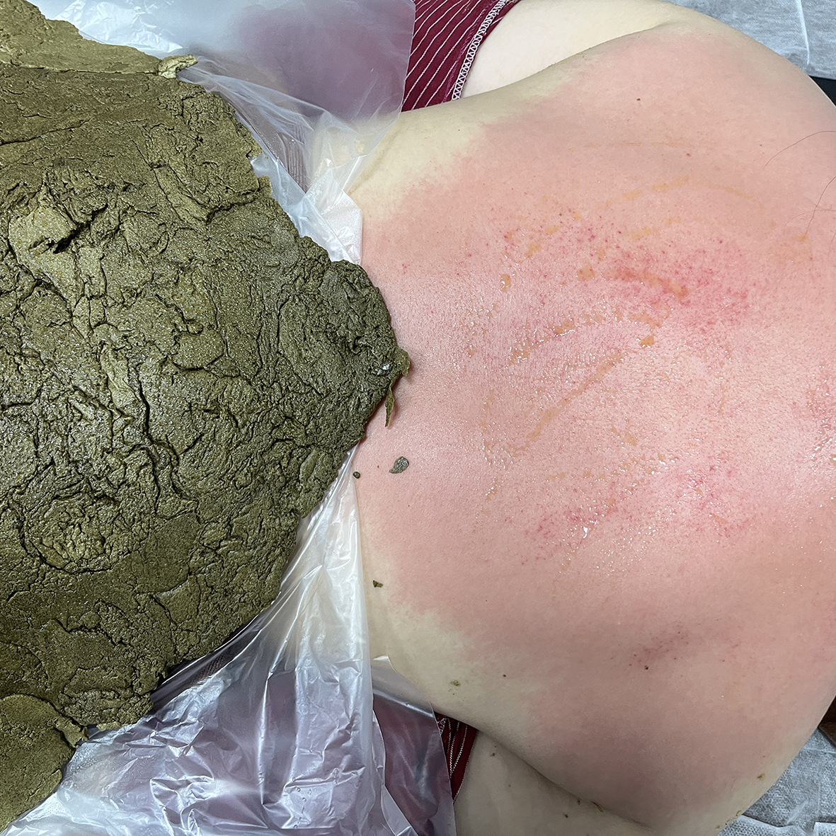 精武门热灸膏使用案例