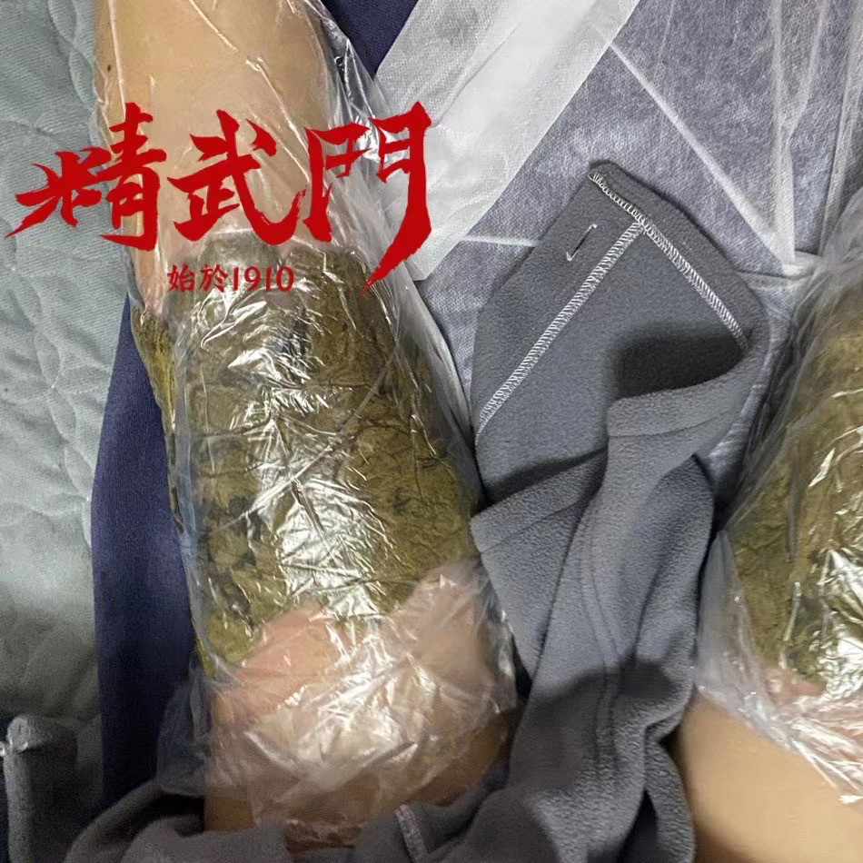 精武门热灸膏使用案例