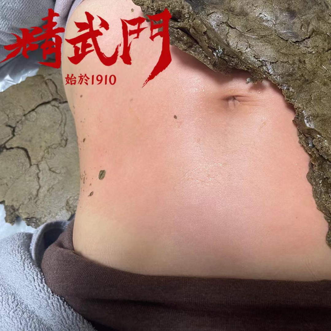 精武门热灸膏使用案例