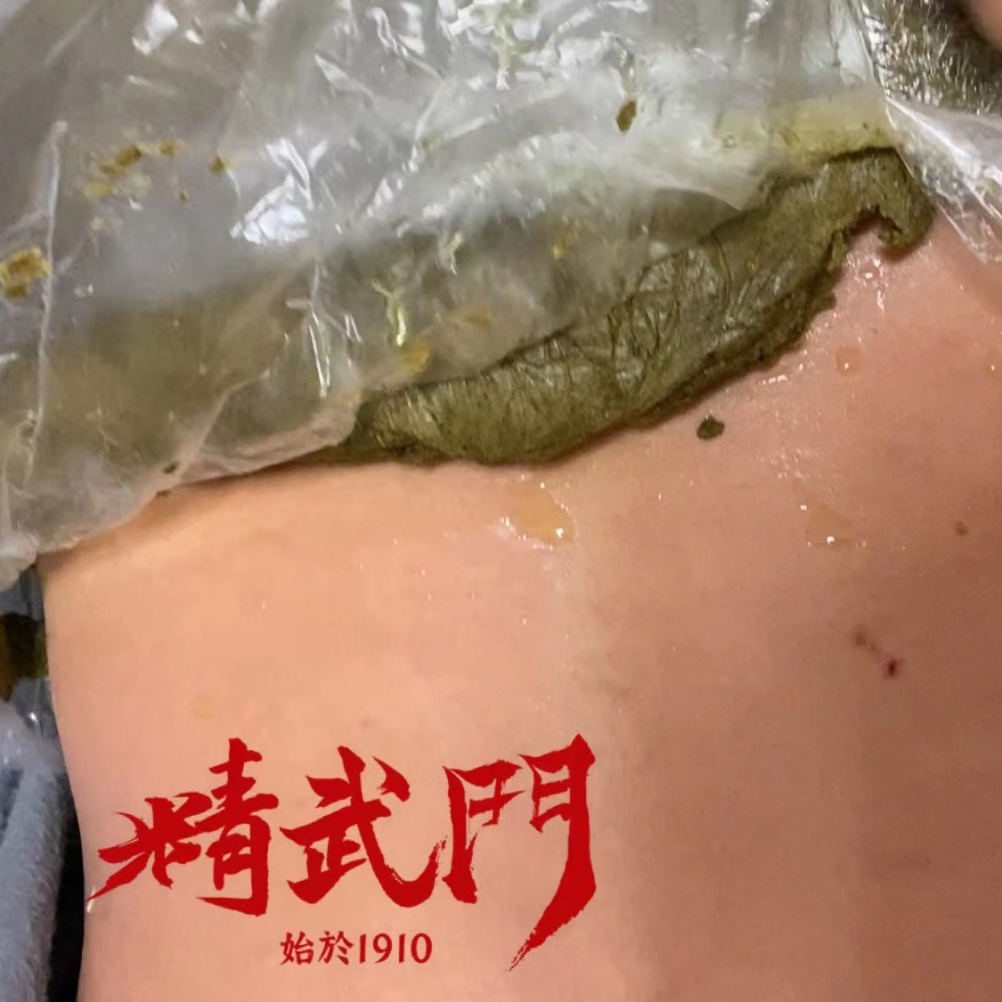 精武门热灸膏使用案例