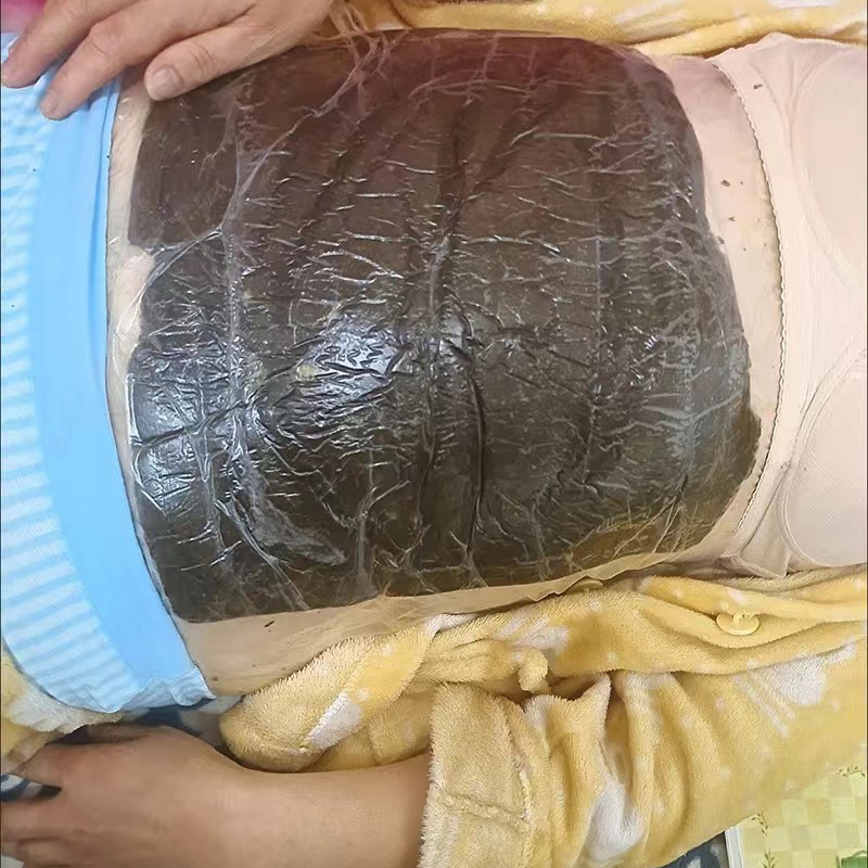 精武门热灸膏使用案例