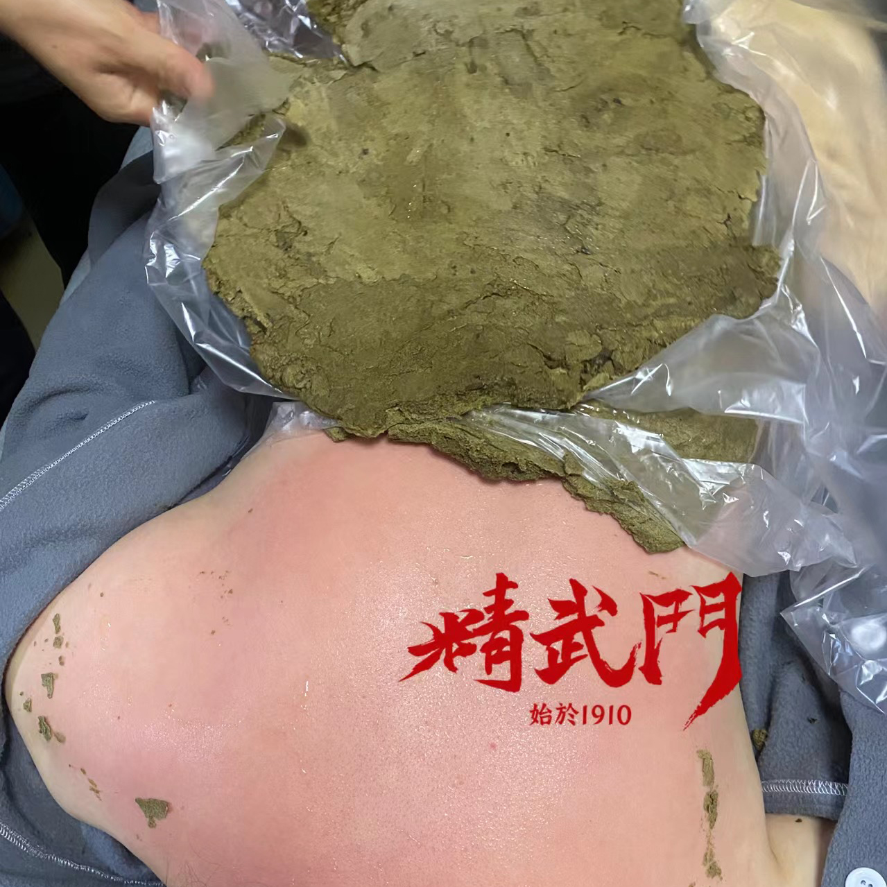 精武门热灸膏使用案例
