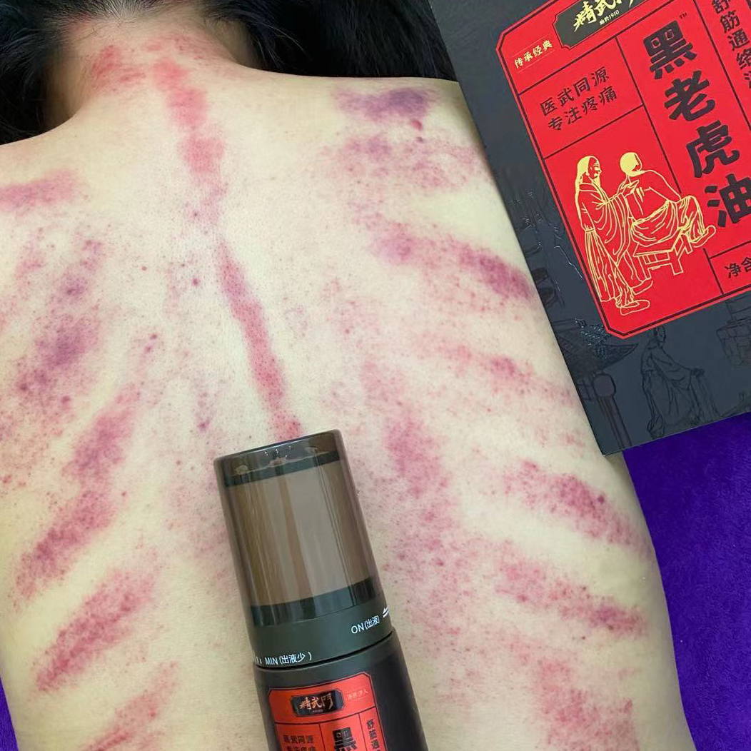 精武门黑老虎油使用案例